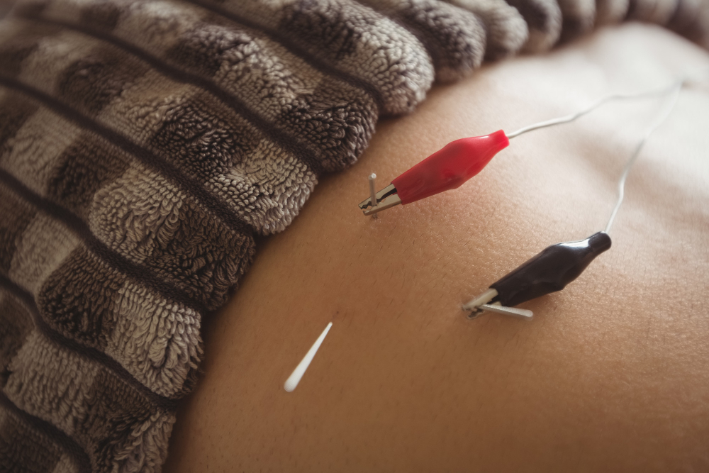 Close-up of a small white acupuncture needle inserted in skin with red and black electrode clips nearby under a folded brown blanket.