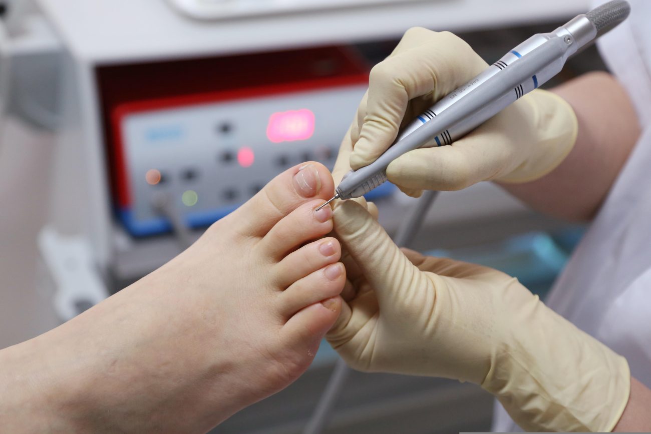 Gloved clinician uses a nail drill on a patient's toenail during a foot care procedure in a clinic.